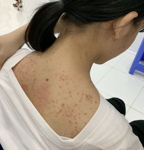Ngứa hoài, coi chừng nhiễm sán chó - Ảnh 4. Ngứa hoài, coi chừng nhiễm sán chó - Ảnh 4.