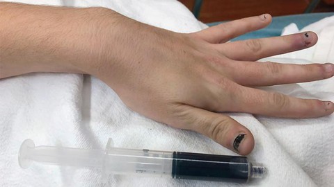 Máu hóa xanh vì dùng quá nhiều thuốc giảm đau - Ảnh 1. Máu hóa xanh vì dùng quá nhiều thuốc giảm đau - Ảnh 1.