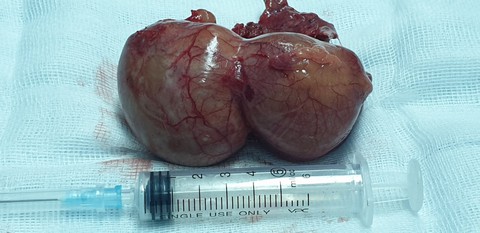 Phát hiện khối nang ngoài màng tim khủng - Ảnh 2. Phát hiện khối nang ngoài màng tim khủng - Ảnh 2.
