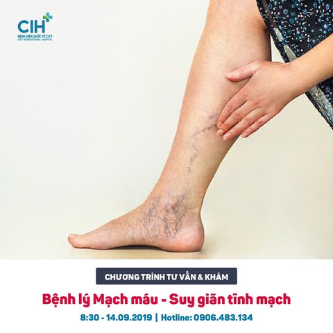 Bệnh viện Quốc tế City khám bệnh lý mạch máu miễn phí - Ảnh 2. Bệnh viện Quốc tế City khám bệnh lý mạch máu miễn phí - Ảnh 2.
