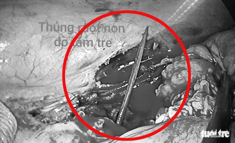 Cụ ông 72 tuổi bị tăm xỉa răng đâm thủng ruột - Ảnh 1. Cụ ông 72 tuổi bị tăm xỉa răng đâm thủng ruột - Ảnh 1.