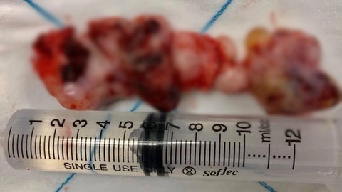 Mũi cậu bé 14 tuổi bị hủy vì u sợi mạch vòm mũi họng dài 12cm - Ảnh 1. Mũi cậu bé 14 tuổi bị hủy vì u sợi mạch vòm mũi họng dài 12cm - Ảnh 1.