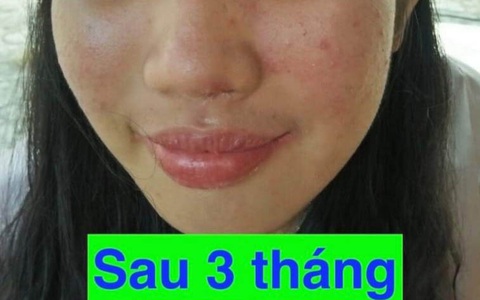 Tạo hình cánh mũi, vành tai bị đứt lìa cho hai nạn nhân bị tai nạn - Ảnh 1. Tạo hình cánh mũi, vành tai bị đứt lìa cho hai nạn nhân bị tai nạn - Ảnh 1.