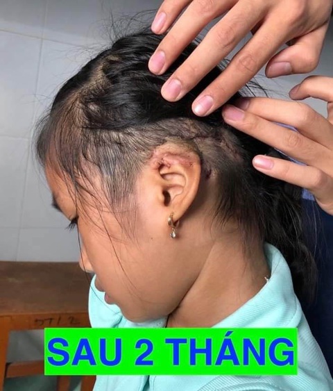 Tạo hình cánh mũi, vành tai bị đứt lìa cho hai nạn nhân bị tai nạn - Ảnh 2. Tạo hình cánh mũi, vành tai bị đứt lìa cho hai nạn nhân bị tai nạn - Ảnh 2.