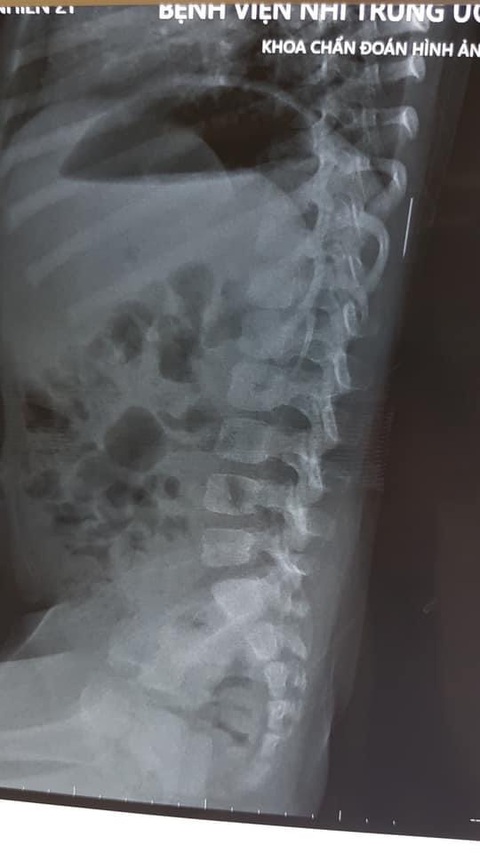 Bé gái 3 tuổi có... chiếc kim dài 17mm ngay gần đốt sống - Ảnh 1. Bé gái 3 tuổi có... chiếc kim dài 17mm ngay gần đốt sống - Ảnh 1.