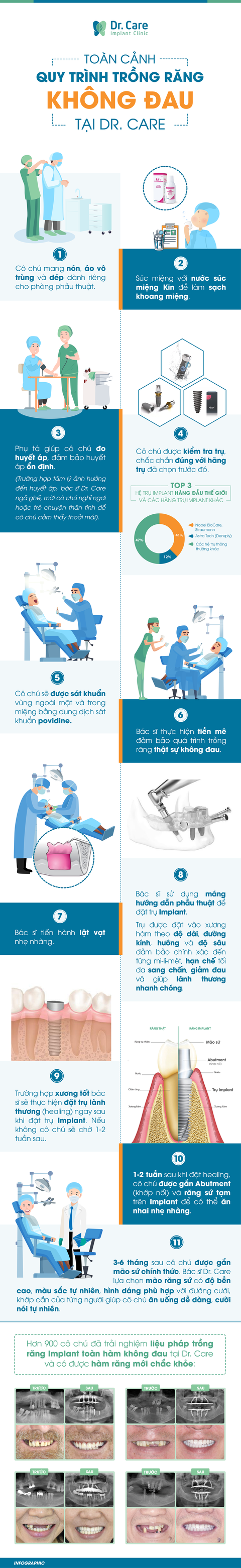 Toàn cảnh ca trồng răng Implant không đau tại nha khoa chuyên sâu - Ảnh 2. Toàn cảnh ca trồng răng Implant không đau tại nha khoa chuyên sâu - Ảnh 2.
