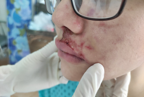 Mặt cô gái sưng phù, mưng mủ sau tiêm filler ở thẩm mỹ viện quận 1 - Ảnh 1. Mặt cô gái sưng phù, mưng mủ sau tiêm filler ở thẩm mỹ viện quận 1 - Ảnh 1.