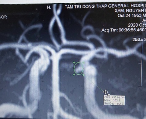 Túi phình động mạch trong não, triệu chứng mơ hồ hậu quả hiện hữu rất lớn - Ảnh 2. Túi phình động mạch trong não, triệu chứng mơ hồ hậu quả hiện hữu rất lớn - Ảnh 2.