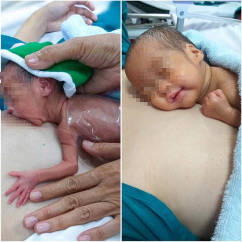 Bé sinh non hồi phục kỳ diệu nhờ kề da mẹ mỗi ngày - Ảnh 1. Bé sinh non hồi phục kỳ diệu nhờ kề da mẹ mỗi ngày - Ảnh 1.