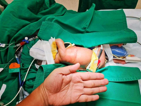 Cứu sống bé gái sinh non, mắc bệnh tim và đa dị tật đường tiêu hóa - Ảnh 1. Cứu sống bé gái sinh non, mắc bệnh tim và đa dị tật đường tiêu hóa - Ảnh 1.