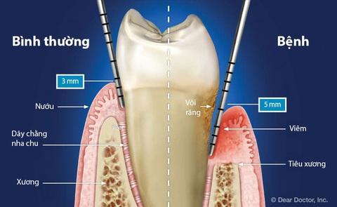 Men vi sinh nha khoa - giải pháp mới cho bệnh viêm nha chu - Ảnh 1. Men vi sinh nha khoa - giải pháp mới cho bệnh viêm nha chu - Ảnh 1.