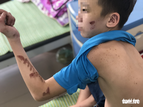 Cậu bé bị chủ quán tra tấn: ‘Bà chủ dùng chảo nấu bánh xèo nóng gí vào tay em’ - Ảnh 3. Cậu bé bị chủ quán tra tấn: ‘Bà chủ dùng chảo nấu bánh xèo nóng gí vào tay em’ - Ảnh 3.