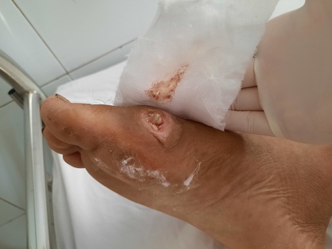 Số ca nhập viện vì vi khuẩn ăn thịt người tăng nhanh ở Đà Nẵng - Ảnh 1. Số ca nhập viện vì vi khuẩn ăn thịt người tăng nhanh ở Đà Nẵng - Ảnh 1.