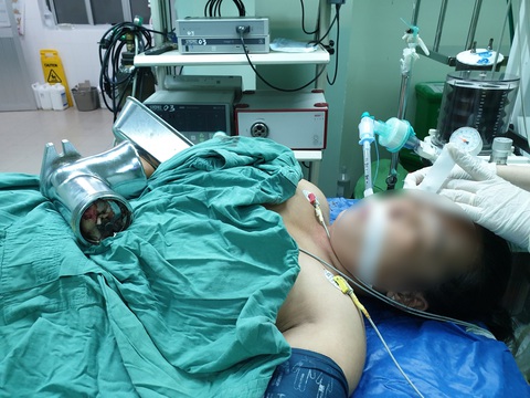 Thêm một trường hợp bị máy xay thịt, cá cuốn giập nát bàn tay - Ảnh 1. Thêm một trường hợp bị máy xay thịt, cá cuốn giập nát bàn tay - Ảnh 1.