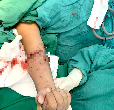 Nối cẳng tay phải bị đứt lìa cho bé trai 8 tuổi - Ảnh 1. Nối cẳng tay phải bị đứt lìa cho bé trai 8 tuổi - Ảnh 1.