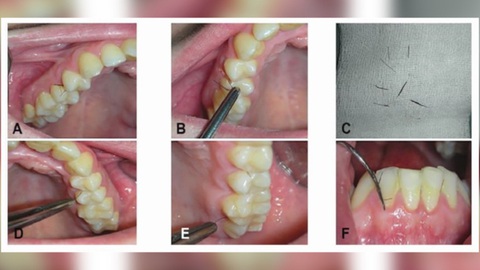Mắc bệnh lạ, người phụ nữ mọc lông ở… lợi - Ảnh 1. Mắc bệnh lạ, người phụ nữ mọc lông ở… lợi - Ảnh 1.