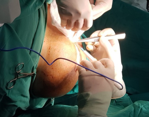 Cắt khối bướu giáp khổng lồ trên cổ nữ bệnh nhân - Ảnh 1. Cắt khối bướu giáp khổng lồ trên cổ nữ bệnh nhân - Ảnh 1.