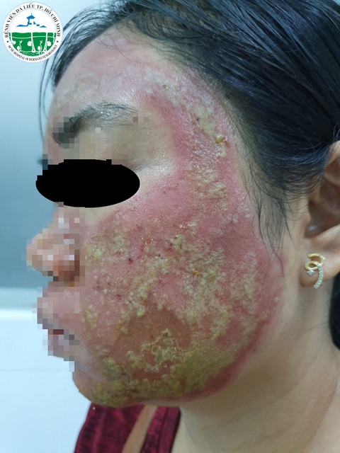 Một phụ nữ bị mưng mủ đầy mặt do tai biến lăn kim tại tiệm spa - Ảnh 1. Một phụ nữ bị mưng mủ đầy mặt do tai biến lăn kim tại tiệm spa - Ảnh 1.