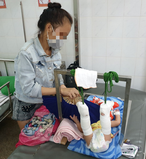 Bé trai 4 tháng tuổi gãy xương, xuất huyết não, bầm nhiều chỗ, người nhà nói té võng - Ảnh 1. Bé trai 4 tháng tuổi gãy xương, xuất huyết não, bầm nhiều chỗ, người nhà nói té võng - Ảnh 1.
