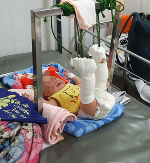 Bé trai 4 tháng tuổi gãy xương, xuất huyết não, bầm nhiều chỗ, người nhà nói té võng - Ảnh 2. Bé trai 4 tháng tuổi gãy xương, xuất huyết não, bầm nhiều chỗ, người nhà nói té võng - Ảnh 2.