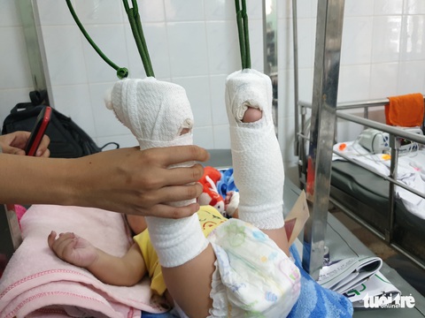 Bé trai 4 tháng tuổi gãy xương, xuất huyết não, bầm nhiều chỗ, người nhà nói té võng - Ảnh 3. Bé trai 4 tháng tuổi gãy xương, xuất huyết não, bầm nhiều chỗ, người nhà nói té võng - Ảnh 3.