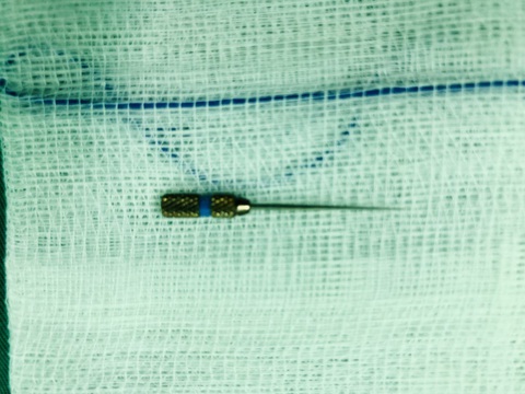 Đi làm răng, nuốt phải kim nha khoa nhọn, dài 4cm - Ảnh 1. Đi làm răng, nuốt phải kim nha khoa nhọn, dài 4cm - Ảnh 1.