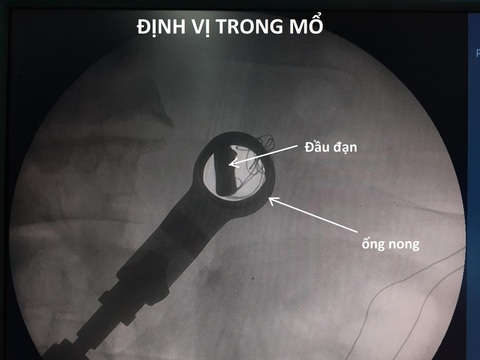 Mổ lấy viên đạn hơn 50 năm trong cơ thể người cựu chiến binh - Ảnh 1. Mổ lấy viên đạn hơn 50 năm trong cơ thể người cựu chiến binh - Ảnh 1.