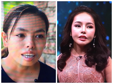 Cô gái bị miệt thị ngoại hình trở nên xinh đẹp hơn nhờ phẫu thuật thẩm mỹ - Ảnh 2. Cô gái bị miệt thị ngoại hình trở nên xinh đẹp hơn nhờ phẫu thuật thẩm mỹ - Ảnh 2.