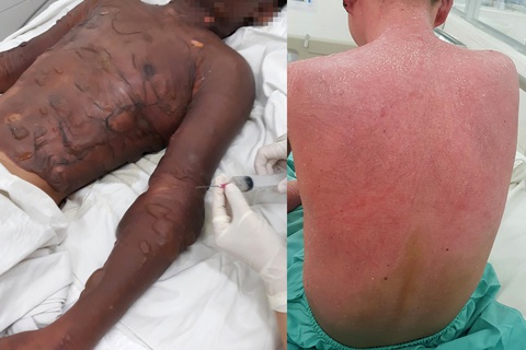 Giúp mẹ chiên đậu phụ bán, một thiếu niên 13 tuổi phỏng từ đầu đến thắt lưng - Ảnh 1. Giúp mẹ chiên đậu phụ bán, một thiếu niên 13 tuổi phỏng từ đầu đến thắt lưng - Ảnh 1.