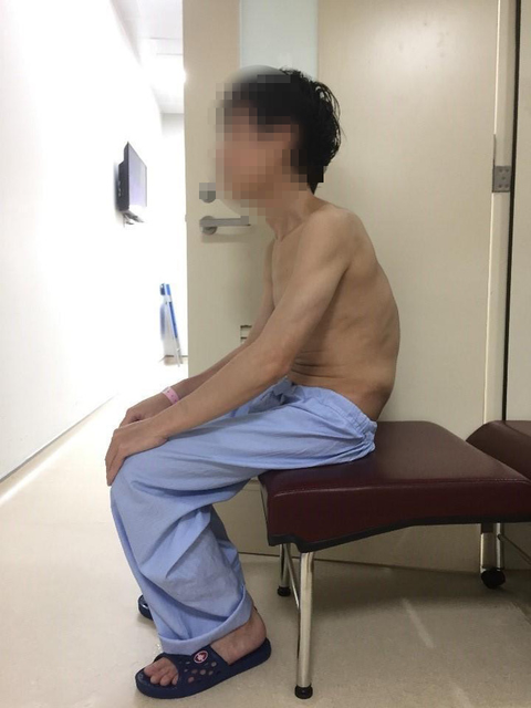 Phẫu thuật nắn chỉnh cột sống cho bệnh nhân 10 năm không được nằm bình thường - Ảnh 2. Phẫu thuật nắn chỉnh cột sống cho bệnh nhân 10 năm không được nằm bình thường - Ảnh 2.