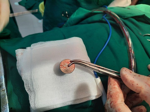 Suýt chết vì đồng xu lọt vào cổ họng khi chơi đùa với con - Ảnh 1. Suýt chết vì đồng xu lọt vào cổ họng khi chơi đùa với con - Ảnh 1.