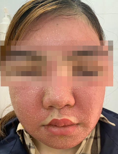 Mặt sưng phù, đầy mụn mủ sau khi đắp mặt nạ mua trên mạng - Ảnh 1. Mặt sưng phù, đầy mụn mủ sau khi đắp mặt nạ mua trên mạng - Ảnh 1.