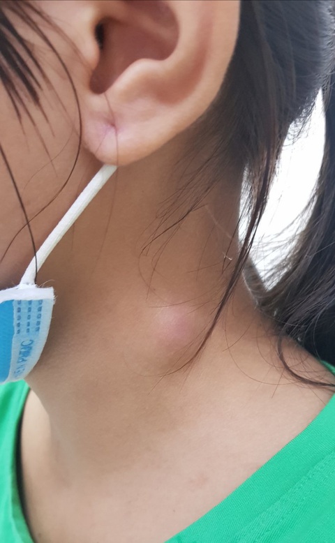 Chữa vuốt xương kiểu dân gian, 5 tháng sau ra cục u vùng cổ - Ảnh 1. Chữa vuốt xương kiểu dân gian, 5 tháng sau ra cục u vùng cổ - Ảnh 1.