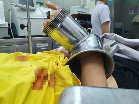 45 phút nghẹt thở cắt máy xay thịt để lấy bàn tay dập nát của một phụ nữ - Ảnh 2. 45 phút nghẹt thở cắt máy xay thịt để lấy bàn tay dập nát của một phụ nữ - Ảnh 2.