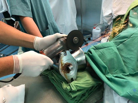 45 phút nghẹt thở cắt máy xay thịt để lấy bàn tay dập nát của một phụ nữ - Ảnh 3. 45 phút nghẹt thở cắt máy xay thịt để lấy bàn tay dập nát của một phụ nữ - Ảnh 3.