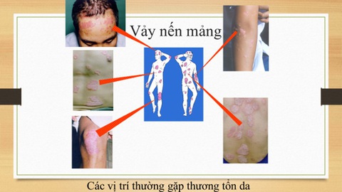 Sống chung với nỗi khốn khổ vảy nến sao cho không... trầm cảm? - Ảnh 3. Sống chung với nỗi khốn khổ vảy nến sao cho không... trầm cảm? - Ảnh 3.