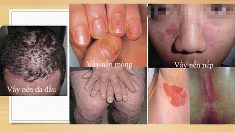Vì sao bệnh vảy nến là nỗi khốn khổ của con người? - Ảnh 2. Vì sao bệnh vảy nến là nỗi khốn khổ của con người? - Ảnh 2.