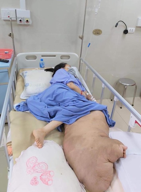 Phẫu thuật giải cứu chân trái khổng lồ, nặng 42kg cho cô gái 25 tuổi - Ảnh 1. Phẫu thuật giải cứu chân trái khổng lồ, nặng 42kg cho cô gái 25 tuổi - Ảnh 1.
