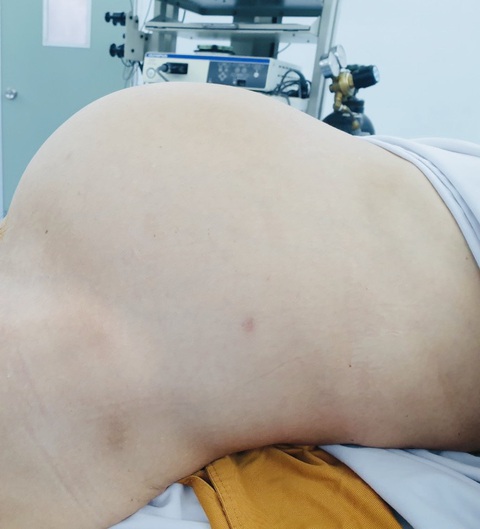 Cắt khối u buồng trứng lớn như có bầu 9 tháng cho nữ bệnh nhân - Ảnh 1. Cắt khối u buồng trứng lớn như có bầu 9 tháng cho nữ bệnh nhân - Ảnh 1.