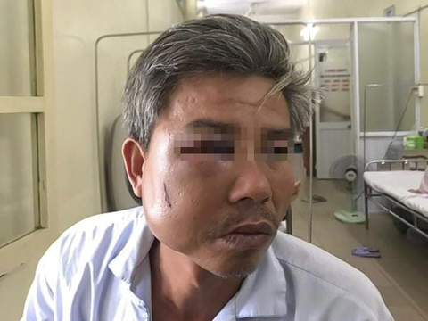 Treo quảng cáo trái phép, chủ cà phê Bố Già còn đánh bầm dập nhân viên Công ty cây xanh - Ảnh 1. Treo quảng cáo trái phép, chủ cà phê Bố Già còn đánh bầm dập nhân viên Công ty cây xanh - Ảnh 1.