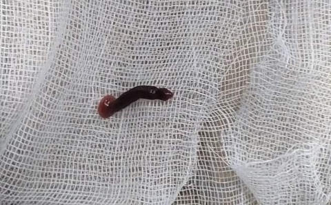 Đi tắm thác, nữ sinh bị đỉa 3cm chui vào mũi - Ảnh 1. Đi tắm thác, nữ sinh bị đỉa 3cm chui vào mũi - Ảnh 1.