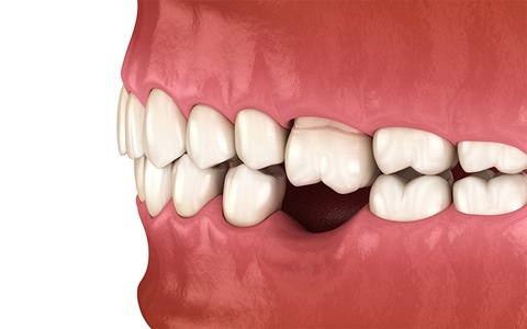 Trồng Implant khôi phục răng vĩnh viễn, tự tin tận hưởng cuộc sống - Ảnh 1. Trồng Implant khôi phục răng vĩnh viễn, tự tin tận hưởng cuộc sống - Ảnh 1.