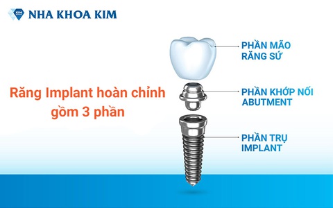 Trồng Implant khôi phục răng vĩnh viễn, tự tin tận hưởng cuộc sống - Ảnh 2. Trồng Implant khôi phục răng vĩnh viễn, tự tin tận hưởng cuộc sống - Ảnh 2.