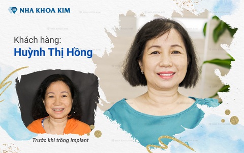 Trồng Implant khôi phục răng vĩnh viễn, tự tin tận hưởng cuộc sống - Ảnh 3. Trồng Implant khôi phục răng vĩnh viễn, tự tin tận hưởng cuộc sống - Ảnh 3.