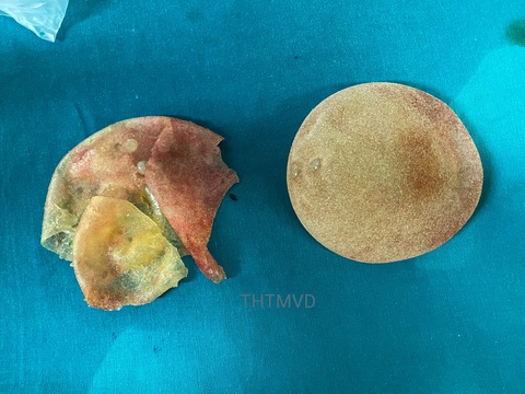 Thấy ngực không tròn đều, đi khám mới hay túi nâng ngực đã vỡ mấy mảnh - Ảnh 1. Thấy ngực không tròn đều, đi khám mới hay túi nâng ngực đã vỡ mấy mảnh - Ảnh 1.