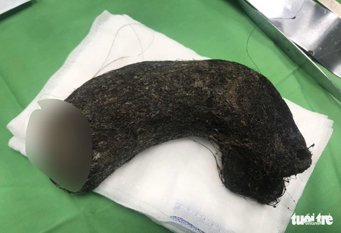 Hi hữu: Búi tóc 1kg trong dạ dày bé gái 11 tuổi - Ảnh 1. Hi hữu: Búi tóc 1kg trong dạ dày bé gái 11 tuổi - Ảnh 1.