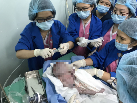 Cứu sống một bé gái có khối u khổng lổ trên mặt lúc chào đời - Ảnh 1. Cứu sống một bé gái có khối u khổng lổ trên mặt lúc chào đời - Ảnh 1.