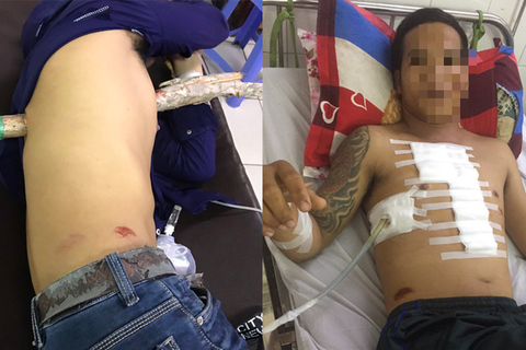 Cứu sống nam thanh niên bị cây tràm đâm xuyên ngực - Ảnh 1. Cứu sống nam thanh niên bị cây tràm đâm xuyên ngực - Ảnh 1.