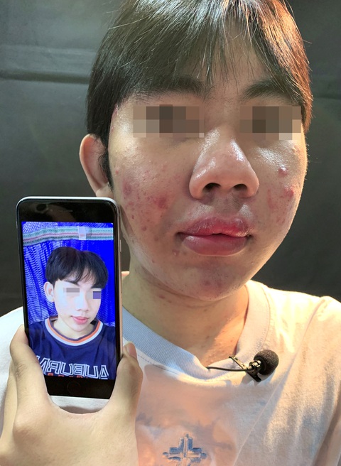 Nạn nhân tiêm silicon: ‘Chích đại vào mặt, môi, ngực, mông... ai xui thì ráng chịu’ - Ảnh 1. Nạn nhân tiêm silicon: ‘Chích đại vào mặt, môi, ngực, mông... ai xui thì ráng chịu’ - Ảnh 1.