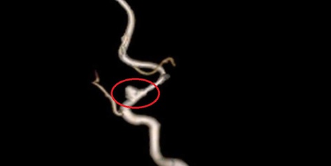 Bé 3 tuổi bị đột quỵ: Có thường gặp, làm sao nhận biết? - Ảnh 1. Bé 3 tuổi bị đột quỵ: Có thường gặp, làm sao nhận biết? - Ảnh 1.